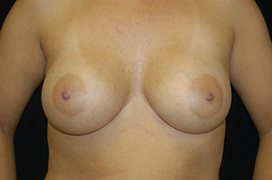 Breast Augmentation 10b